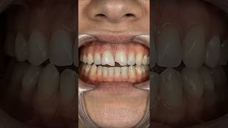 Restoring a Chipped Front Tooth | Smile Makeover Transformation #shorts
