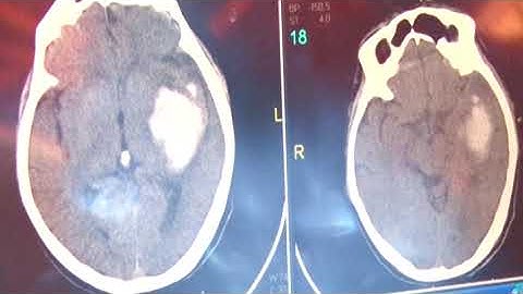 Bệnh viện Gia An 115 ứng dụng phần mềm trí tuệ nhân tạo RAPID trong chẩn đoán và điều trị đột quỵ
