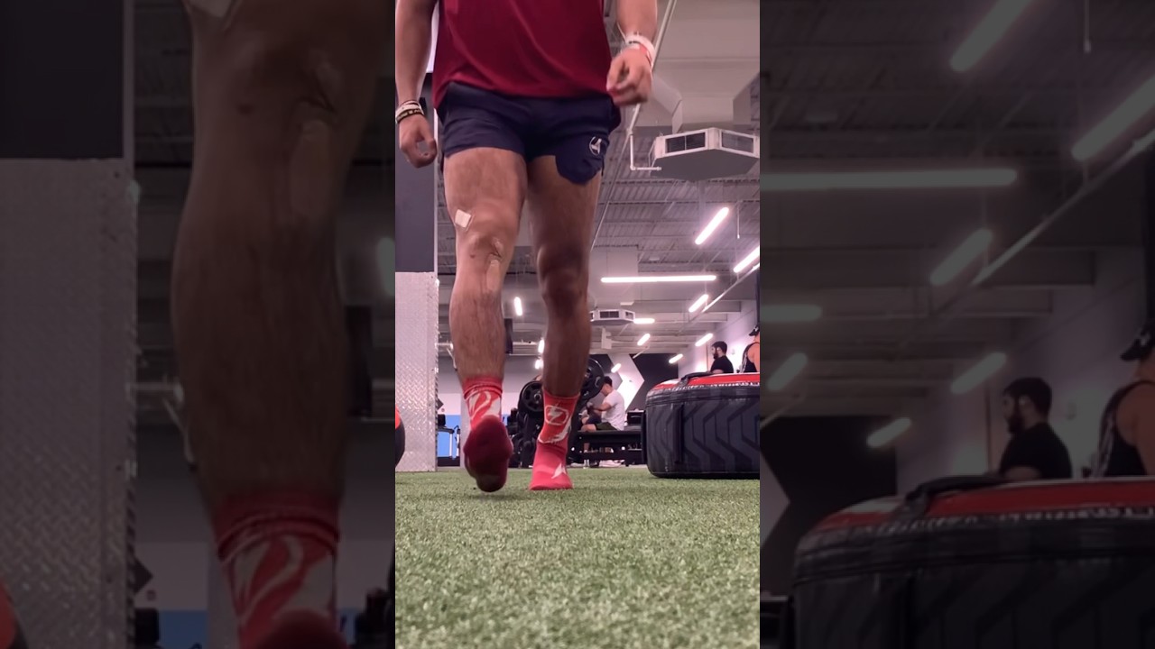 ACL Surgery Day 12…I’m walking normal now! 