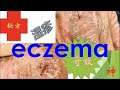 太棒了！终于找到治疗湿疹的秘方了（1: 简介）That's great! Finally a cure for eczema (1: Introduction)