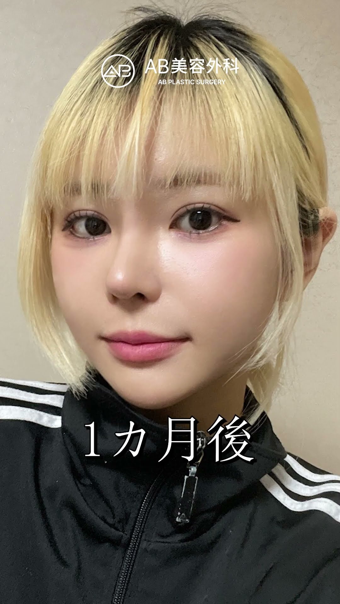 【韓国整形】目整形・鼻整形・顔面輪郭整形で韓国アイドル級の垢抜け完成♥️ #韓国整形 #shorts