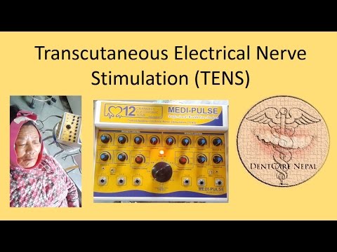 Treatment of Trigeminal Neuralgia - TENS