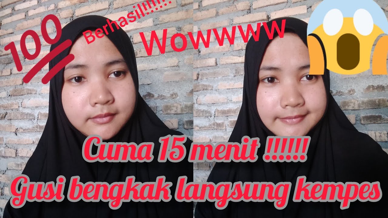 cara mengempeskan gusi bengkak dengan cepat 