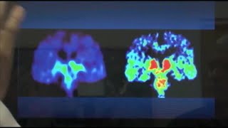 Key to treating Alzheimer’s may lie within immune system, UVA researchers say