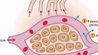 Mechanisms of edema development