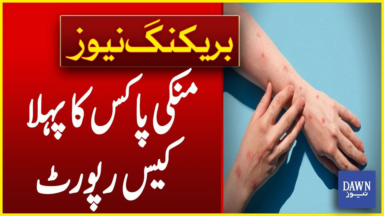 First Case Of MonkeyPox Records In Pakistan | Breaking News | Dawn News ...