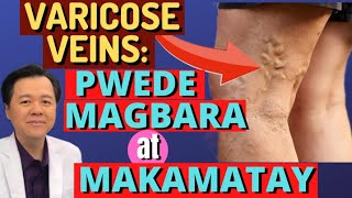 Varicose Veins: Pwede Magbara at Makamatay - By Doc Willie Ong (Internist and Cardiologist) #1438