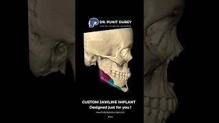 Custom Jaw Implants in India | Jawline Surgery in Delhi | Dr. Punit Dubey