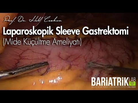 Laparoskopik Tüp Mide (Mide Küçültme) Ameliyatı / Sleeve Gastrectomy