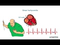 Sinus Tachycardia - A condition with faster-than-usual heart rhythm