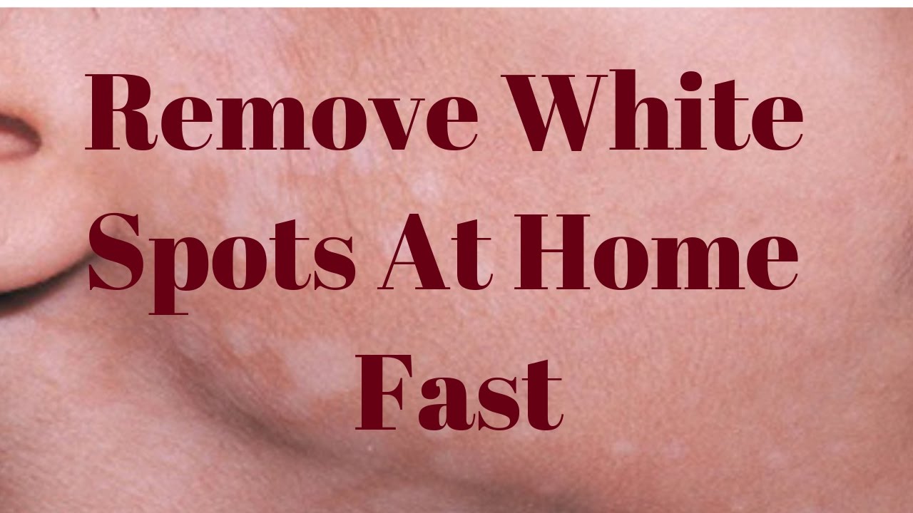 Remove White Spots On Face Only 3 Remedies Youtube