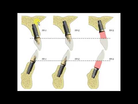 Video: Parodontita Apicală - Simptome, Tratament, Forme, Etape, Diagnostic