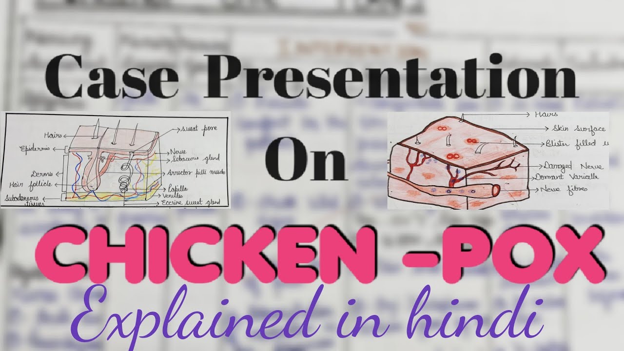 Case Presentation On CHICKEN POX NCP On Chicken Pox Bsc Nursing case-presentation-on-chicken-pox-ncp-on-chicken-pox-bsc-nursing