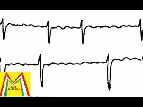ФИБРИЛЛЯЦИЯ ПРЕДСЕРДИЙ. ЛЕЧЕНИЕ