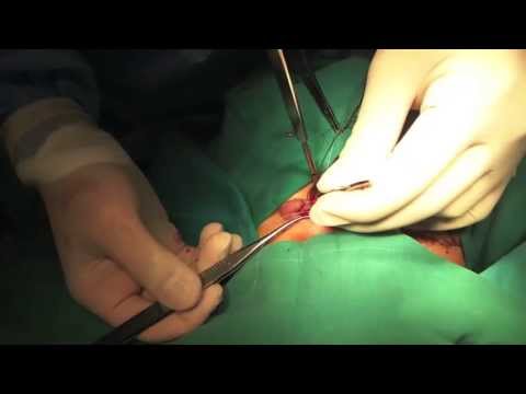 Tarsotomy and Upper Lid Marginal Rotation for Entropion