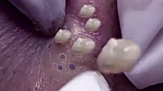Big Cystic Acne Blackheads Extraction Blackheads & Milia, Whiteheads Removal Pimple Popping #019 screenshot 3