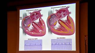 "trombosi" l'importanza della terapia anticoagulante.