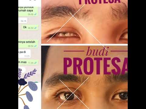 Video: Apa itu eksenterasi mata?