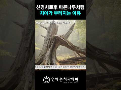 신경치료 후 마른나무처럼 치아가 부러지는 이유 | 부산치과 연세온치과의원 — 연세온치과 유튜브 영상 썸네일