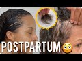 POSTPARTUM HAIR LOSS and PREGNANCY SCARE 👀