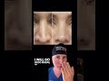 Complex revision rhinoplasty of the pinched nasal tip.