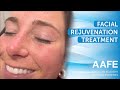 Facial rejuvenation treatment