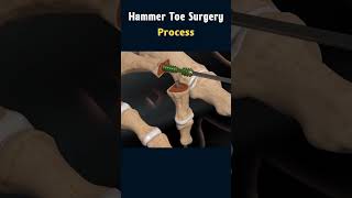 Hammer Toe Surgery: Understanding the Procedure #surgeryanimation