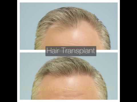 Dallas Male Hair Transplant Before and After