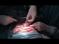 How to give stitch the proper way surgeon on beast mode dr yogesh sadh