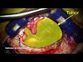 Surgical resection of two metastatic melanoma of the brain. Brain Surgery