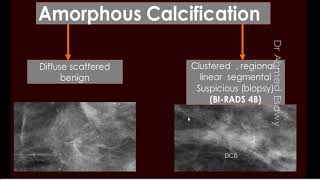 4 sonomammography ACR BIRAD breast calcification