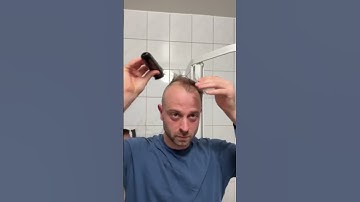 Balding Man Shocked By EPIC Transformation