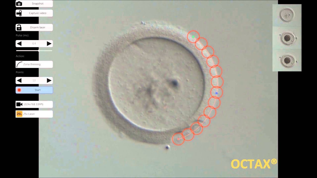 OCTAX NaviLase Zona thinning - YouTube