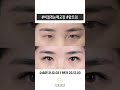 [Before&amp;After] 비절개눈매교정 앞트임 l 르미엘성형외과