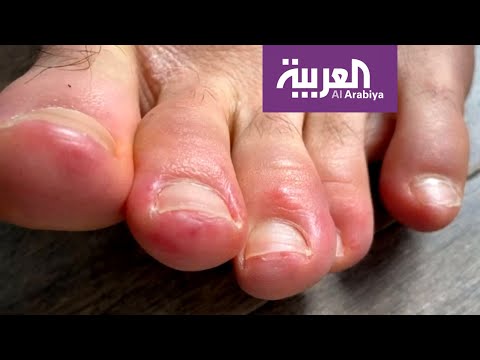 فيديو: هل كوفيد أصابع القدم تسبب الحكة؟