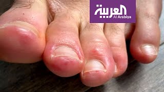 أصابع القدم.. أعراض جديدة للإصابة بكورونا