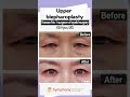 50s60s upper blepharoplasty for droopy eyes before and after at symphonyplasticsurgerykorea