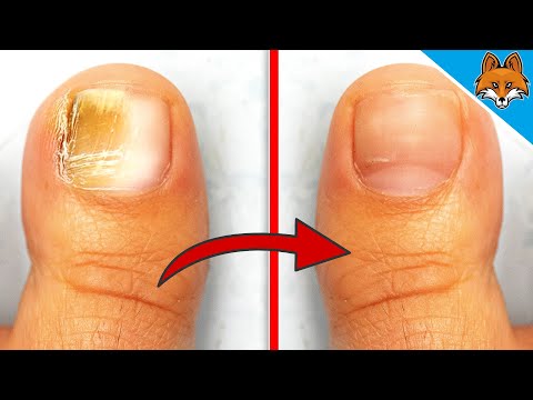 How To Remove Nail Fungus Permanently At Home