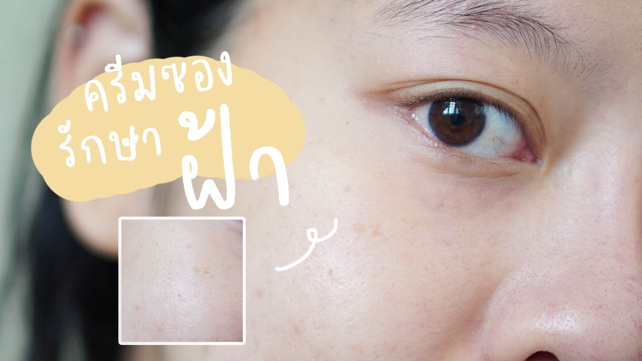 รักษาฝ้า กระ จุดด่างดำ ด้วยครีมซอง | Smileye
