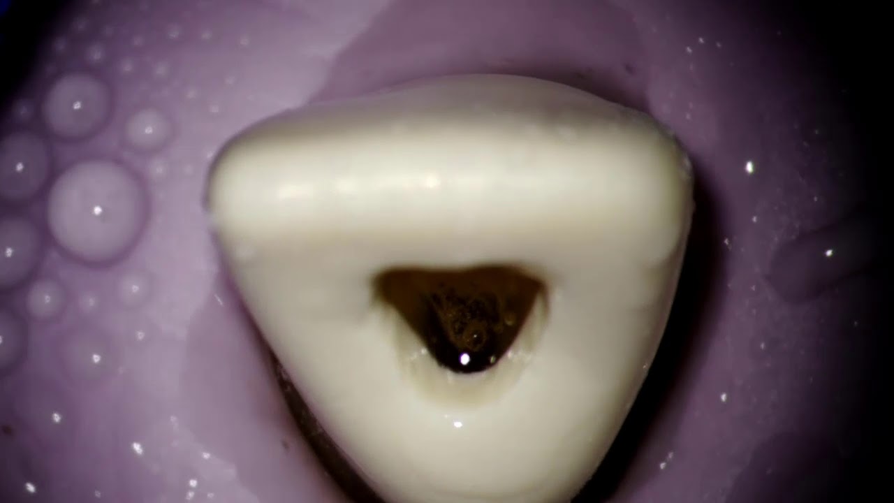 IOD Endodontics Access Cavity YouTube iod-endodontics-access-cavity-youtube