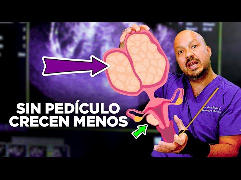 Video: ¿Qué significa pedunculado?