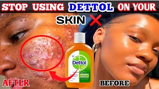 How to use DETTOL ANTISEPTIC LIQUID on your skin for acne & pimples:Stop using Dettol the wrong way