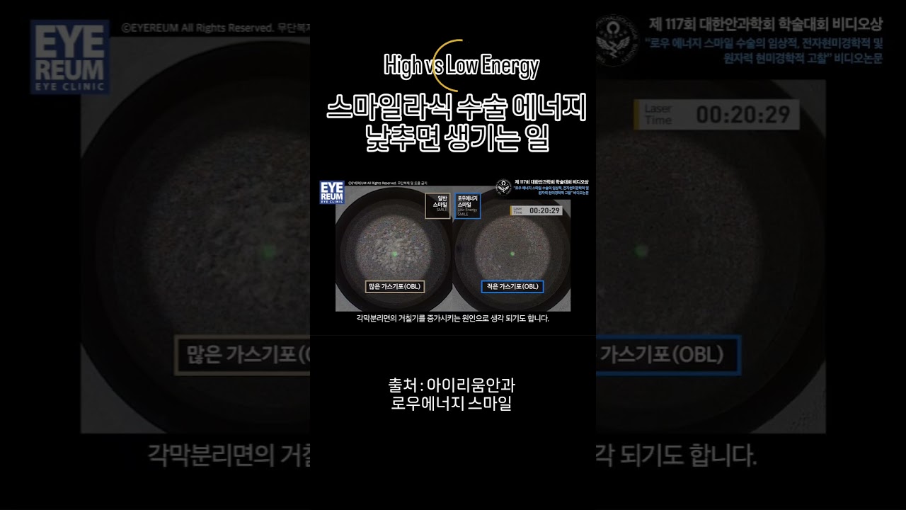 [Айриум нүдний эмнэлэг] СМАЙЛ ЛАСИК мэс засал, эрчим хүчийг бууруулахад юу болдог вэ #Айриумнүднийэмнэлэг #БагаЭрчимХүчнийСМАЙЛ