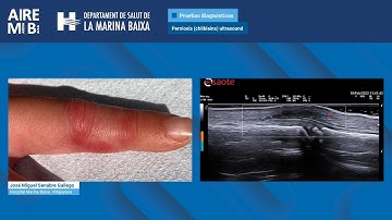 Perniosis (chilblains) ultrasound