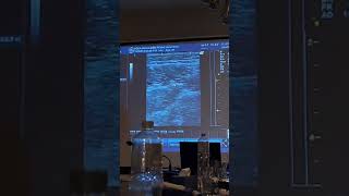 how to view median nerve through musculoskeletal ultrasound