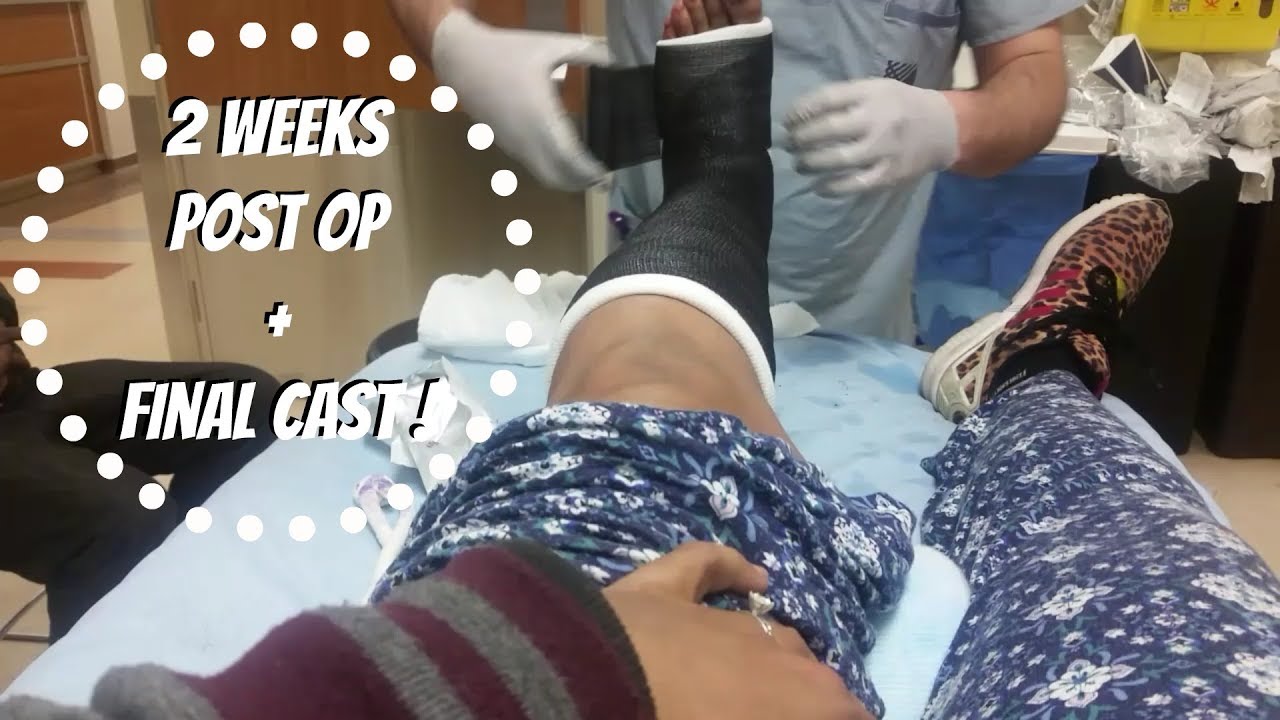2 WEEKS POST OP + FINAL CAST ! - Vlog #7 [SZN4] - YouTube
