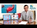 Colonoscopy/ Sigmoidoscopy (in Hindi) Dr. Shravan Bohra, liver specialist,Apollo,Ahmedabad