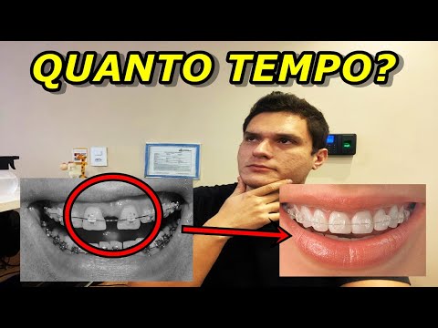 Vídeo: Quanto tempo o aparelho carriere funciona?