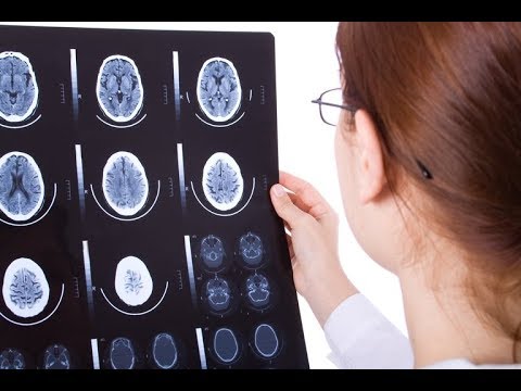 Wideo: Obrzęk Mózgu: Przyczyny, Objawy I Leczenie
