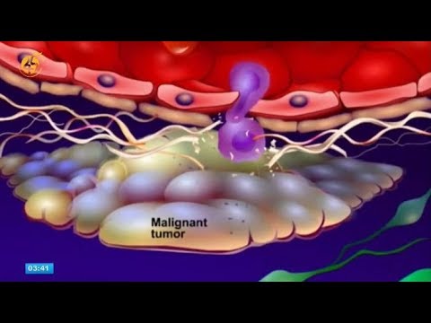 ቪዲዮ: ፖሊፕ ካንሰር ሊያመጣ ይችላል?